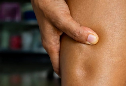 小腿水腫 小腿水腫