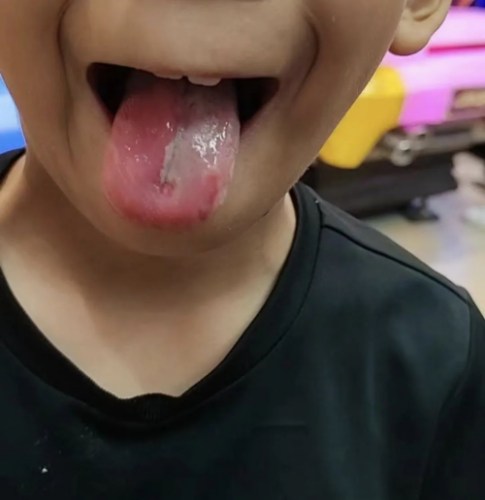 患者舌苔缺一塊 患者舌苔缺一塊