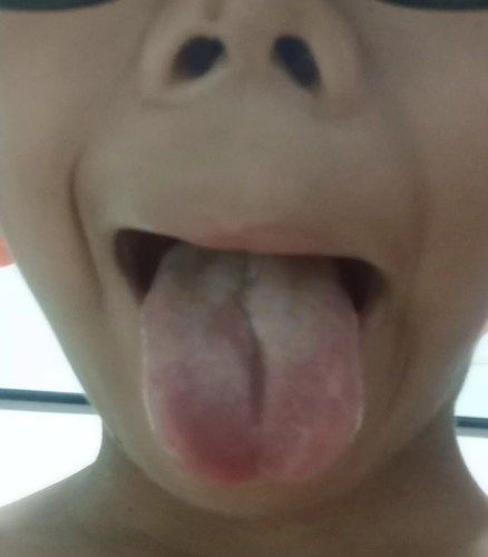 舌苔調(diào)理后的效果 舌苔調(diào)理后的效果