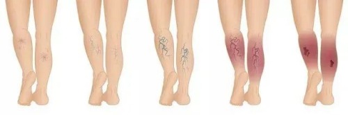 腿部靜脈舒張嚴(yán)重情況 腿部靜脈舒張嚴(yán)重情況