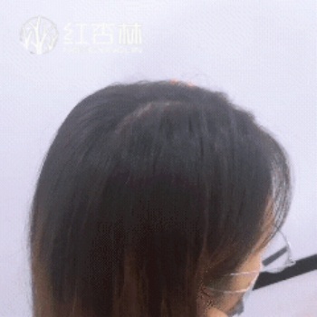 百會穴所在位置 百會穴所在位置