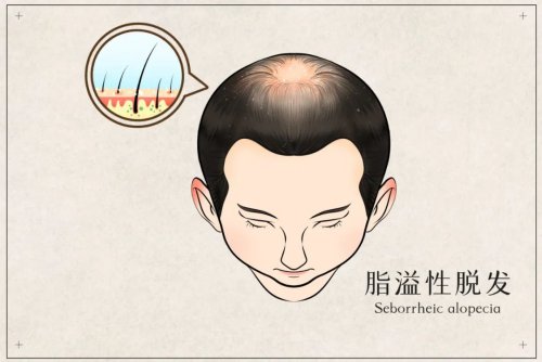脂溢性脫發 脂溢性脫發