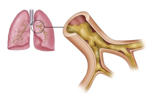 肺里積的痰 肺里積的痰