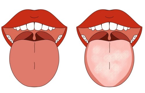舌苔顏色對比 舌苔顏色對比
